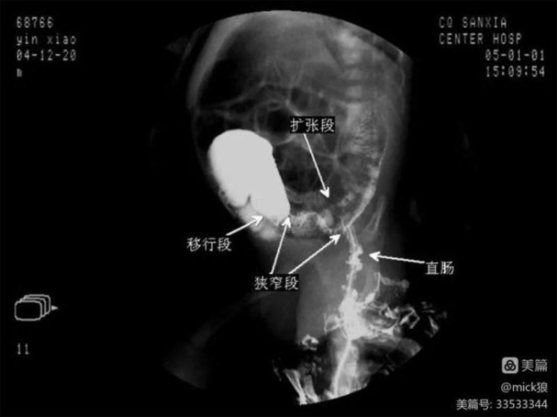 女子在家自行灌肠导致水中毒，医生紧急提醒，操作需谨慎