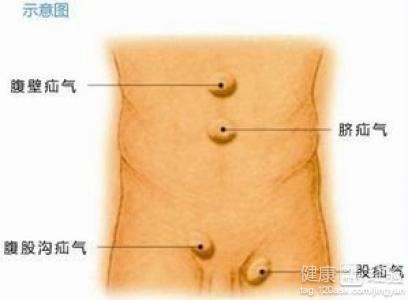 做疝气手术睾丸被摘